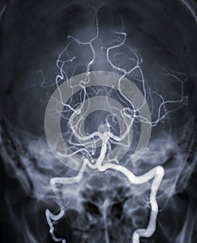 Cerebral angiography  imageor potesterior cerebral artery from Fluoroscopy in intervention radiology  showing Basilar artery