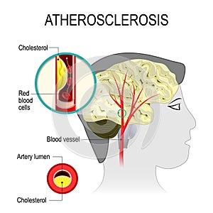 Cerebral artery with atherosclerosis