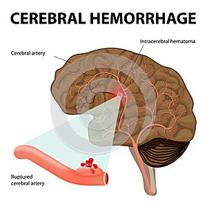 Cerebral hemorrhage photo