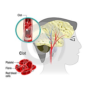 Cerebral infarction