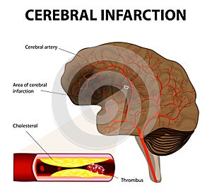 Cerebral infarction or ischemic stroke photo