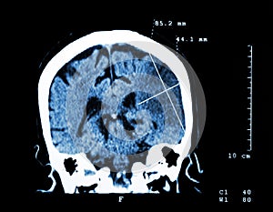 Cerebral infarction at left hemisphere ( Ischemic stroke ) ( CT-scan of brain ) : Medicine and Science background photo