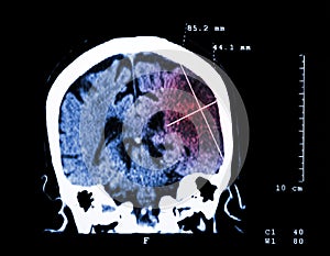 Cerebral infarction at left hemisphere ( Ischemic stroke ) ( CT-scan of brain ) : Medicine and Science background