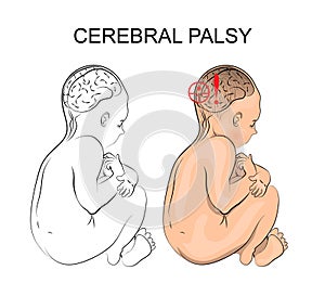 Cerebral palsy. neurology