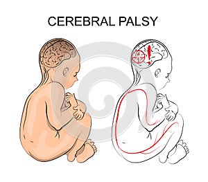 Cerebral palsy. neurology photo