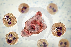 Cerebrospinal fluid smear containing brain-eating amoeba Naegleria fowleri and neutrophils