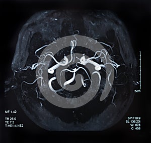 Cerebrovascular in the brain