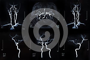 Cerebrovascular in the brain