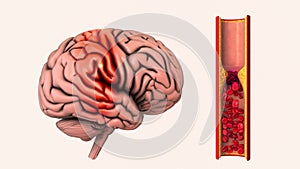 Cerebrovascular disease is an ischemic stroke