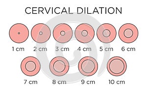 Cervial Dilation Medical Illustration - chart in centimeters