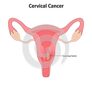 Cervical cancer vector illustration