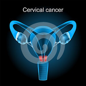 Cervical cancer. Cut-away view of the uterus