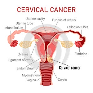 Cervical cancer. Diseases of the female reproductive system. Gynecology. Medical concept. Infographic banner.
