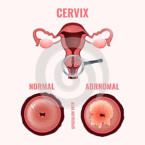 Cervicale cancro immagine 