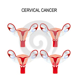Cervical cancer staging. Carcinoma of Cervix. photo
