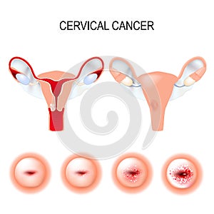 Cervical cancer staging photo