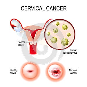 Cervical cancer. uterus, cervix, and close-up of the Human papillomavirus