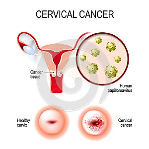 Cervicale cancro. utero, un da Uomo 