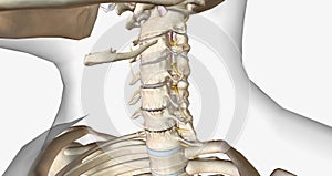 Cervical disc degeneration, or cervical disc disease, is a process that occurs naturally with age