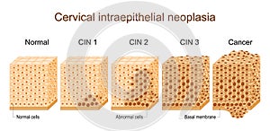 Cervical dysplasia. Cervical cancer