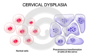 Cervical dysplasia. Cervical cancer