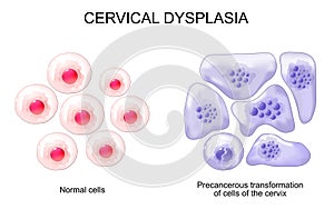 Cervical dysplasia. Cervical cancer photo