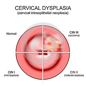 Cervical dysplasia. Close-up of a cervix. Cervical cancer