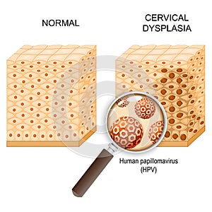Cervical dysplasia and Human papillomavirus infection