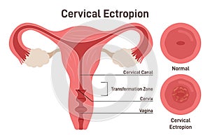 Cervical ectropion or erosion. Cervical canal cells extend on to the surface