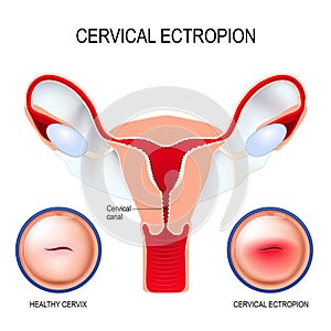 Cervical ectropion. cervical erosion photo