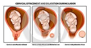 Cervical effacement and dilatation