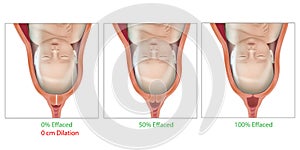 Cervical Effacement and Dilation During Delivery. Cervix, Labor or delivery. Effaced 0, 50,100