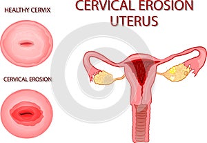 CERVICAL EROSION. The UTERUS photo