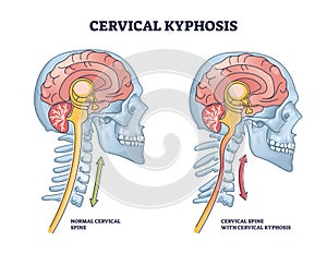 Cervical kyphosis condition with spine and neck curvature outline diagram