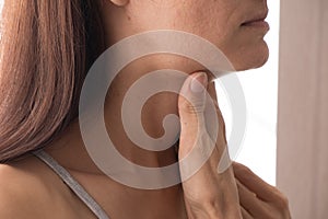 Cervical lymphadenitis of the right side in a woman. photo