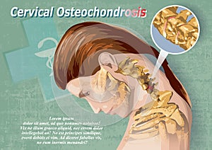 Cervical Osteochondrosis photo