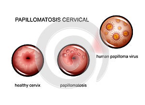 Cervical papillomatosis. human papilloma virus photo