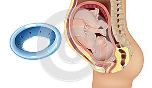 Gynecological and obstetric pessary. Cervical pessary in pregnant women with a short cervix. Modeling of effective photo