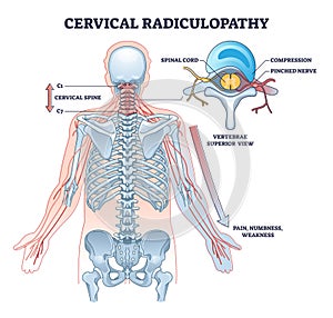 Cervical radiulopathy as painful neck nerve irritation outline diagram