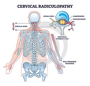 Cervical radiulopathy as painful neck nerve irritation outline diagram photo