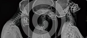 Cervical x-ray of a woman after injury