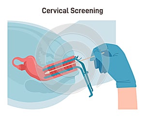 Cervical screening, gynecological examining concept. Cervix cancer