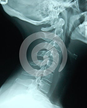 Cervical Spine