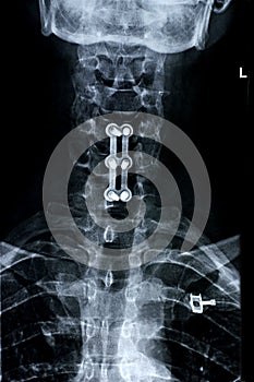 Cervical spine/front