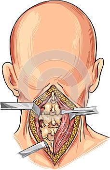 Cervical Spine illustration