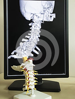 Cervical spine model and MRI picture