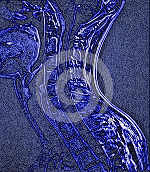 spinal cord tumor, illustration, MRI