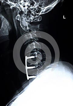 Cervical spine/side