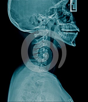 Cervical spine spondylosis