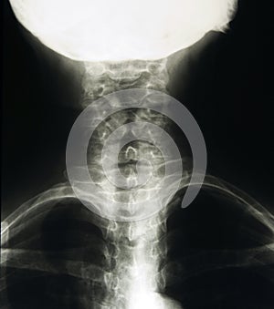 Cervical spine x-ray, neck